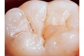 unsealed tooth